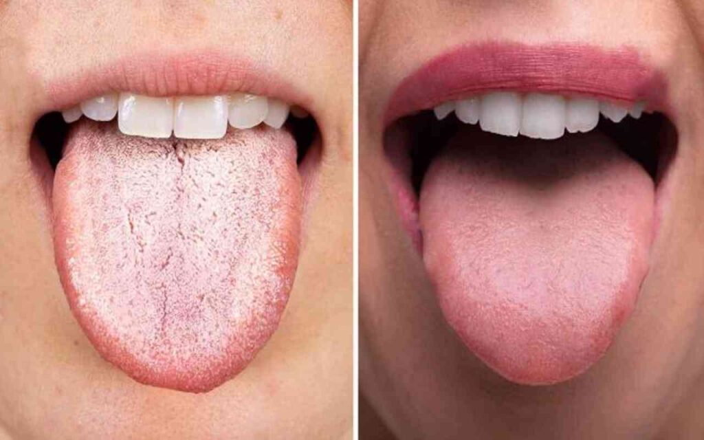 Controlla la tua lingua: se ci sono questi segni corri subito dal medico